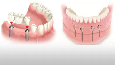İmplant Diş Nedir?