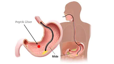 Ülser Belirtileri ve Tedavi Yöntemleri