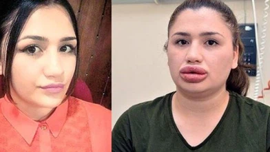 Sağlık Bakanlığından Dudak Dolgusu Olayına Açıklama Geldi