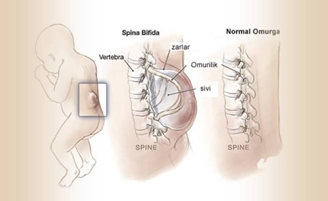 Spina Bifida Nedir?