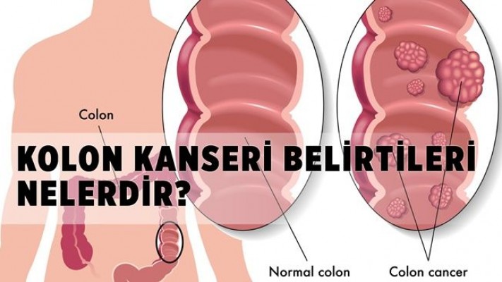 Bağırsak Kolon Kanseri ve Tedavisi