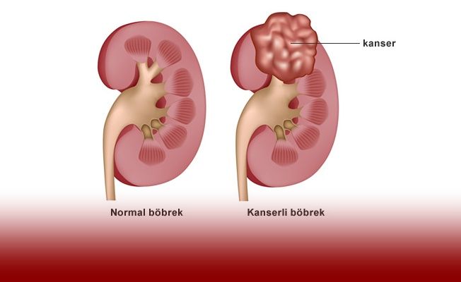 Böbrek Kanseri ve Nedenleri