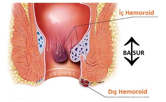 Hemoroid (Basur) Tedavisi