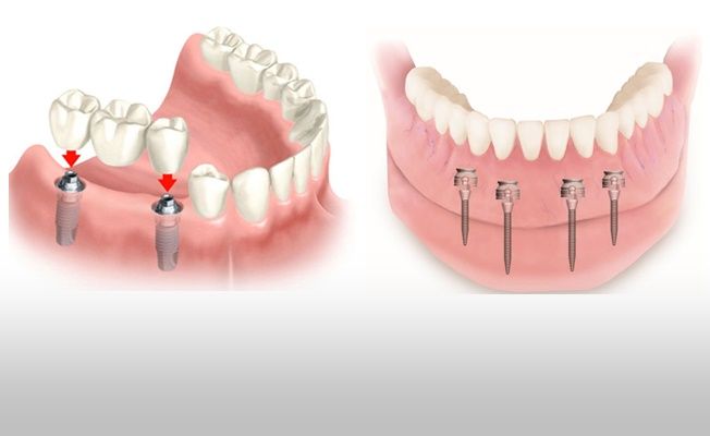 İmplant Diş Nedir?