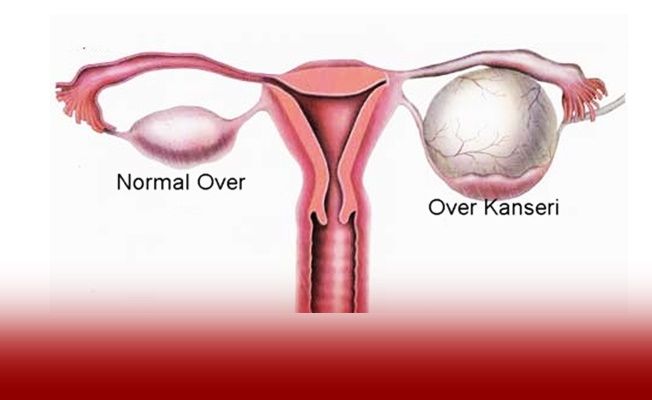 Over Kanseri ve Tedavisi