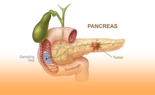 Pankreas Kanseri ve Tedavisi