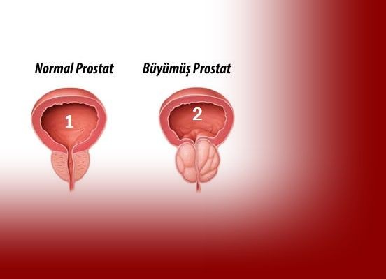 PROSTAT KANSERİ VE TEDAVİSİ